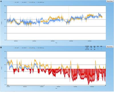 Regional Cerebral Oximetry as an Indicator of Acute Brain Injury in Adults Undergoing Veno-Arterial Extracorporeal Membrane Oxygenation–A Prospective Pilot Study